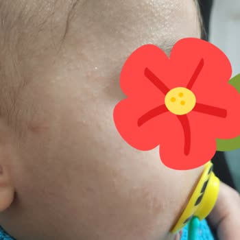 Mi bebé desarrolla erupciones y alergias con productos Mustela