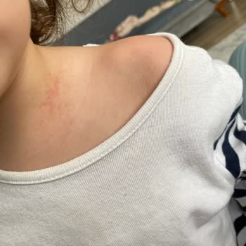 Mustela Champú Provoca Irritación en la Piel de Mi Hija de 2 Años