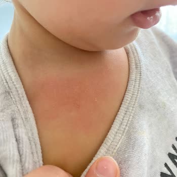 Mustela Champú Provoca Irritación en la Piel de Mi Hija de 2 Años