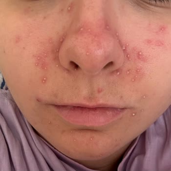 Reacción grave a Mustela Protector Solar tras un día de uso