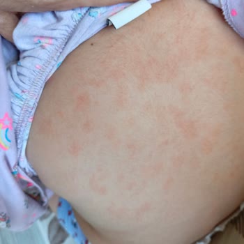 Mustela Champú y Crema Hidratante Causaron Eczema en Mi Bebé