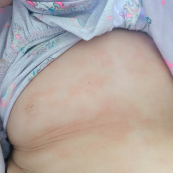 Mustela Champú y Crema Hidratante Causaron Eczema en Mi Bebé