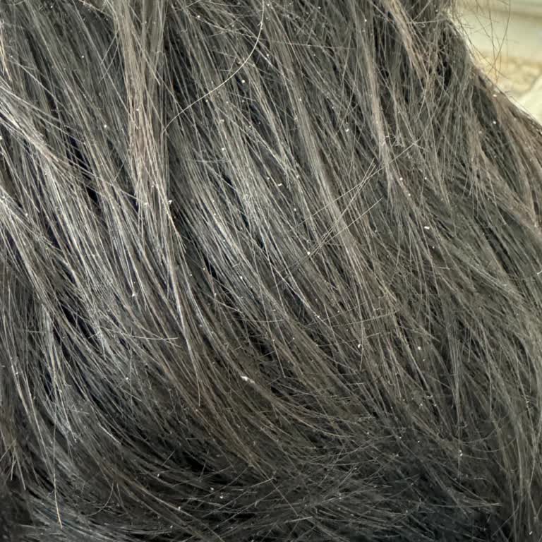 Vichy Dercos Champú Anticaída Causó Caspa y Adelgazamiento