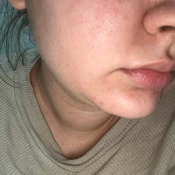 Garnier Vitamin C Productos de Cuidado Facial Me Causaron Acné Grave