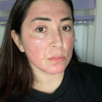 Reacción alérgica con productos de cuidado de la piel de Amway