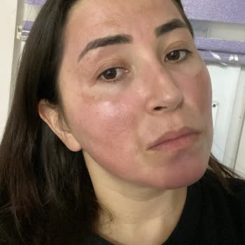 Reacción alérgica con productos de cuidado de la piel de Amway