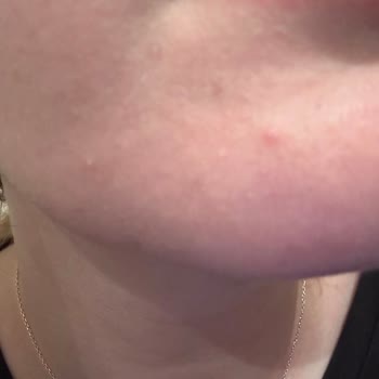 Nyx Bare With Me Corrector Me Causó Acné