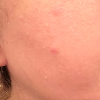 Nyx Bare With Me Corrector Me Causó Acné