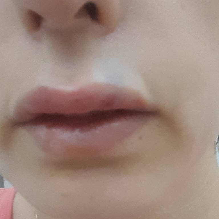 Uzman Estetisyen Gizem Yenice Dolguların Kısa Sürede Bozulması Ve İlgisizlik!