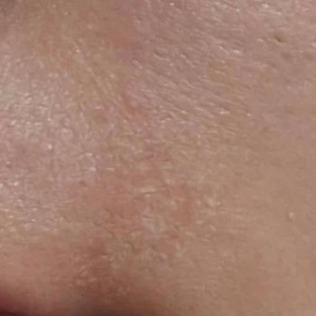 Biowet Markalı Ağda Bandının Zararı