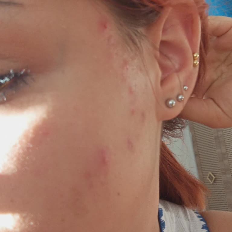 Gabrini Kozmetik Yüzümde Sivilce Yokken Sivilce Çıkarttı