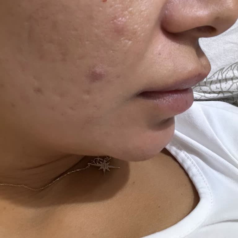 MiaBella Güzellik Merkezi Yanlış Dudak Dolgusu