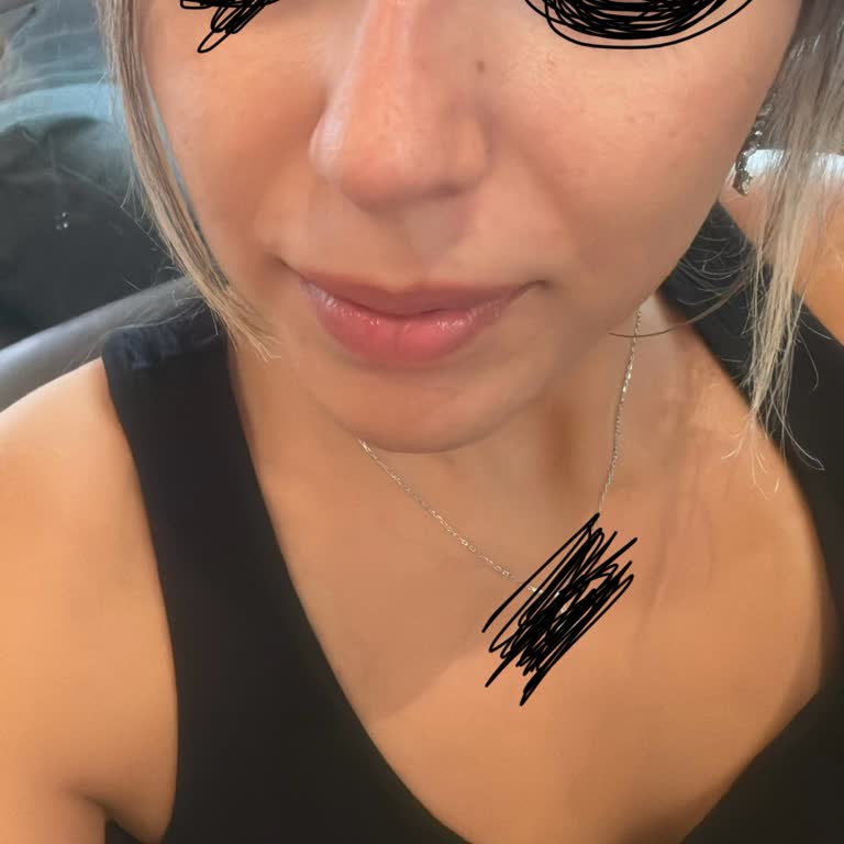 Estpoint Burun Dolgusu Ve Botoks Faciası