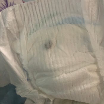 Molfix Bebek Bezi İçinden Siyah Cisim