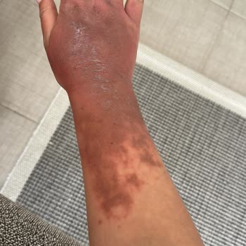 Emsan Çaydanlık Ve 3. Derece Yanık