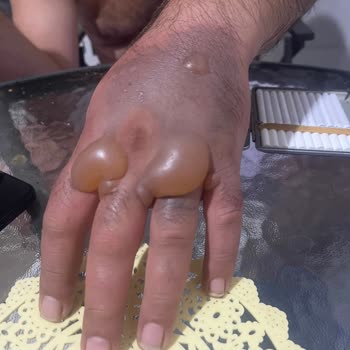 Emsan Çaydanlık Ve 3. Derece Yanık