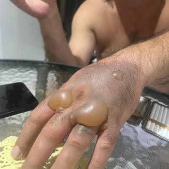 Emsan Çaydanlık Ve 3. Derece Yanık