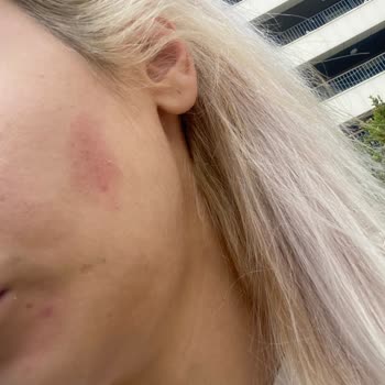 Orva İlaç Sanayi Expigment Yüzümü Yaktı