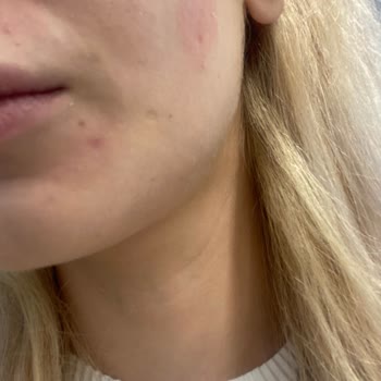 Orva İlaç Sanayi Expigment Yüzümü Yaktı