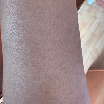 Ankara Özel HLC Polikliniği Lazer Mağduriyetim Şikayetim