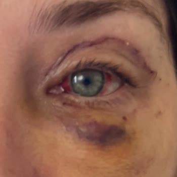 Yrd. Doç. Dr. Sezgin Kurt Ameliyat Sonrası Mağduriyet