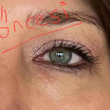 Yrd. Doç. Dr. Sezgin Kurt Ameliyat Sonrası Mağduriyet