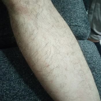 Elçin Güzellik Salonu Lazer Epilasyon Tam Bir Fiyasko