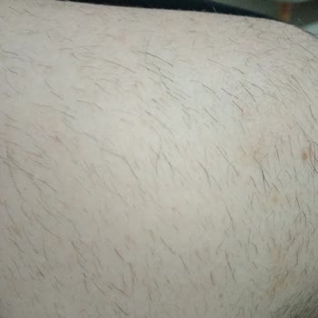 Elçin Güzellik Salonu Lazer Epilasyon Tam Bir Fiyasko