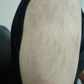 Elçin Güzellik Salonu Lazer Epilasyon Tam Bir Fiyasko