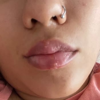 Melek Durak Güzellik Merkezi İşlemler Sonrası Pişmanlığım