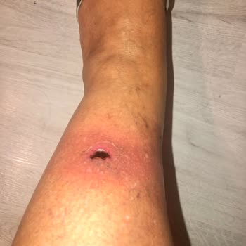 Inday Klinik Köpük Tedavisi Sonrası Ayağımda Açık Yara Ve Enfeksiyon