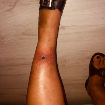 Inday Klinik Köpük Tedavisi Sonrası Ayağımda Açık Yara Ve Enfeksiyon