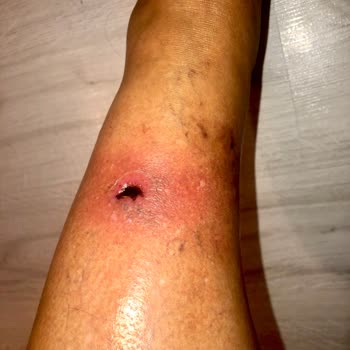 Inday Klinik Köpük Tedavisi Sonrası Ayağımda Açık Yara Ve Enfeksiyon