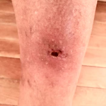 Inday Klinik Köpük Tedavisi Sonrası Ayağımda Açık Yara Ve Enfeksiyon