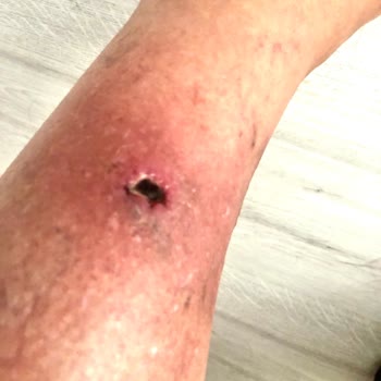Inday Klinik Köpük Tedavisi Sonrası Ayağımda Açık Yara Ve Enfeksiyon