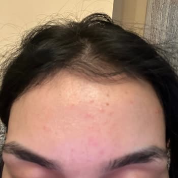 Nivea Face Cleanser Caused Breakouts and Burning After Just 2 Days