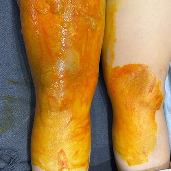 Homend Tea Maker Exploded After 3 Months – Burn Injury Due to Boiling Water