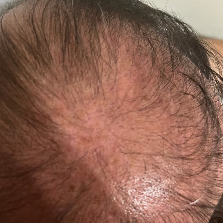 Acıbadem Hastanesi Saç Ekimi Sıfır