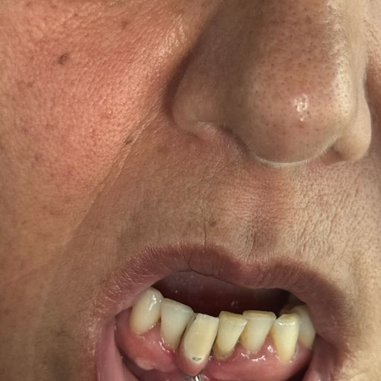 Superdent Ağız Ve Diş Sağlığı İmplant Tedavisinde Yaşanan Büyük Hayal Kırıklığı