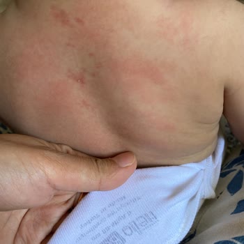 ebebek Bebek Zıbını Alerji