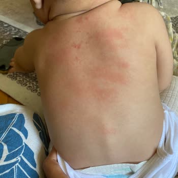 ebebek Bebek Zıbını Alerji