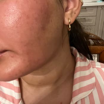 S'he Vec. Serum Kullanımı Yüz Yanma