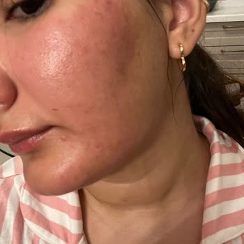 S'he Vec. Serum Kullanımı Yüz Yanma