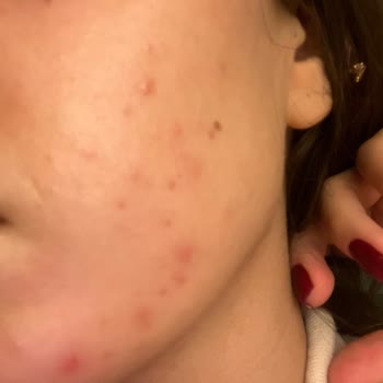 Bioderma Atoderm Sivilce Yaptı