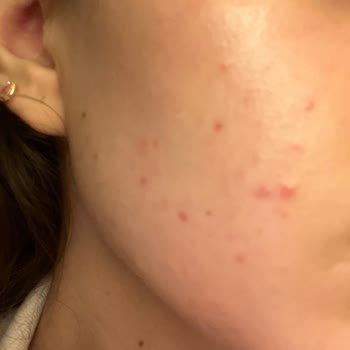Bioderma Atoderm Sivilce Yaptı
