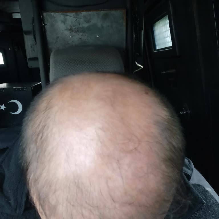 Acıbadem Saç Protez Merkezi Acıbadem Ataşehir Saç Ekim Merkezi