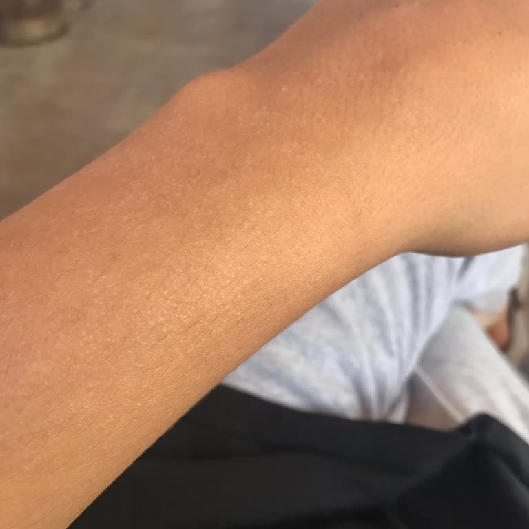 Celenes By Sweden Beklenmeyen Alerjik Reaksiyon Kuruluk Pütürlülük