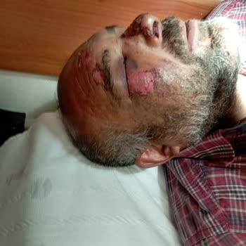 Sanko Üniversitesi Hastanesi Pansuman Odasında Göz Ve Çeneme Dikiş Atıldı Enfeksiyon Oldu Bu .