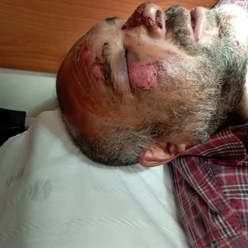 Sanko Üniversitesi Hastanesi Pansuman Odasında Göz Ve Çeneme Dikiş Atıldı Enfeksiyon Oldu Bu .