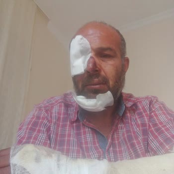 Sanko Üniversitesi Hastanesi Pansuman Odasında Göz Ve Çeneme Dikiş Atıldı Enfeksiyon Oldu Bu .
